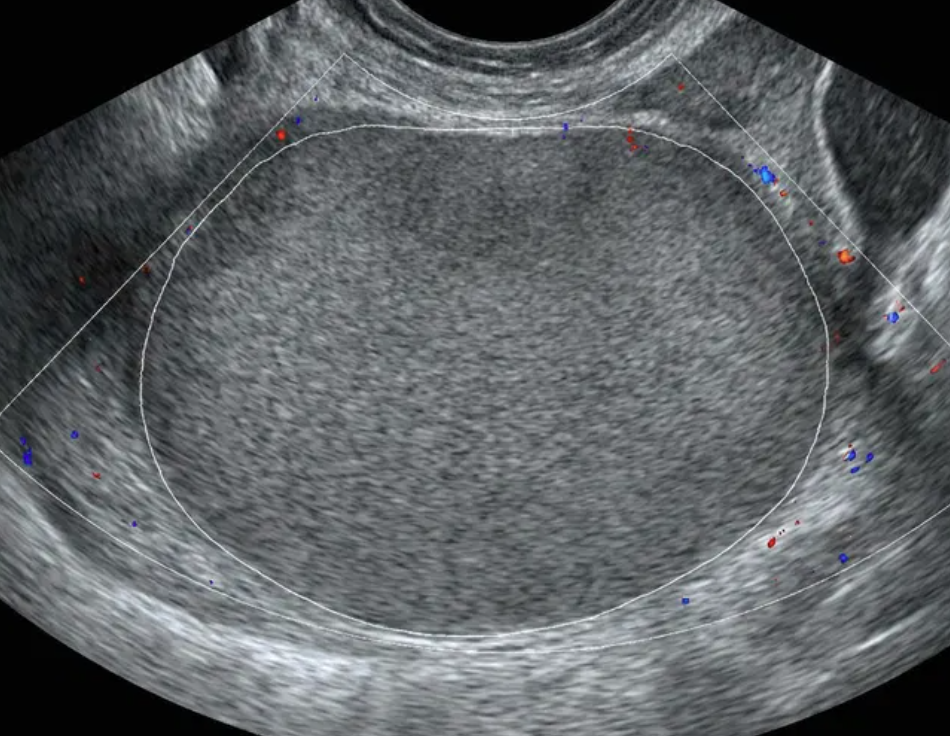 Ilustração: Lesão sólida, superfície lisa, qualquer tamanho, IC = 1